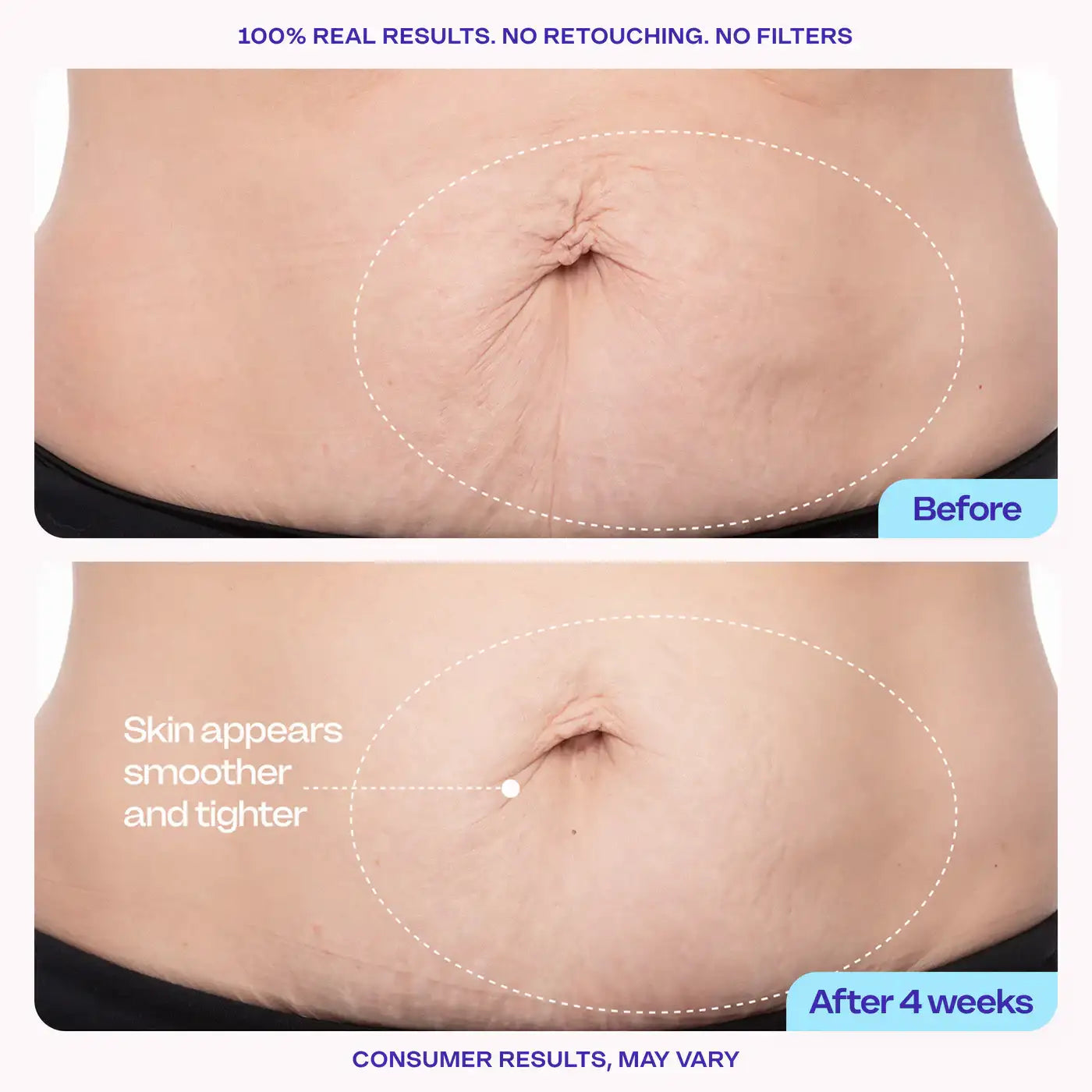 👉 Today only: 70% off your first order - Tighten & Smooth Belly Cream