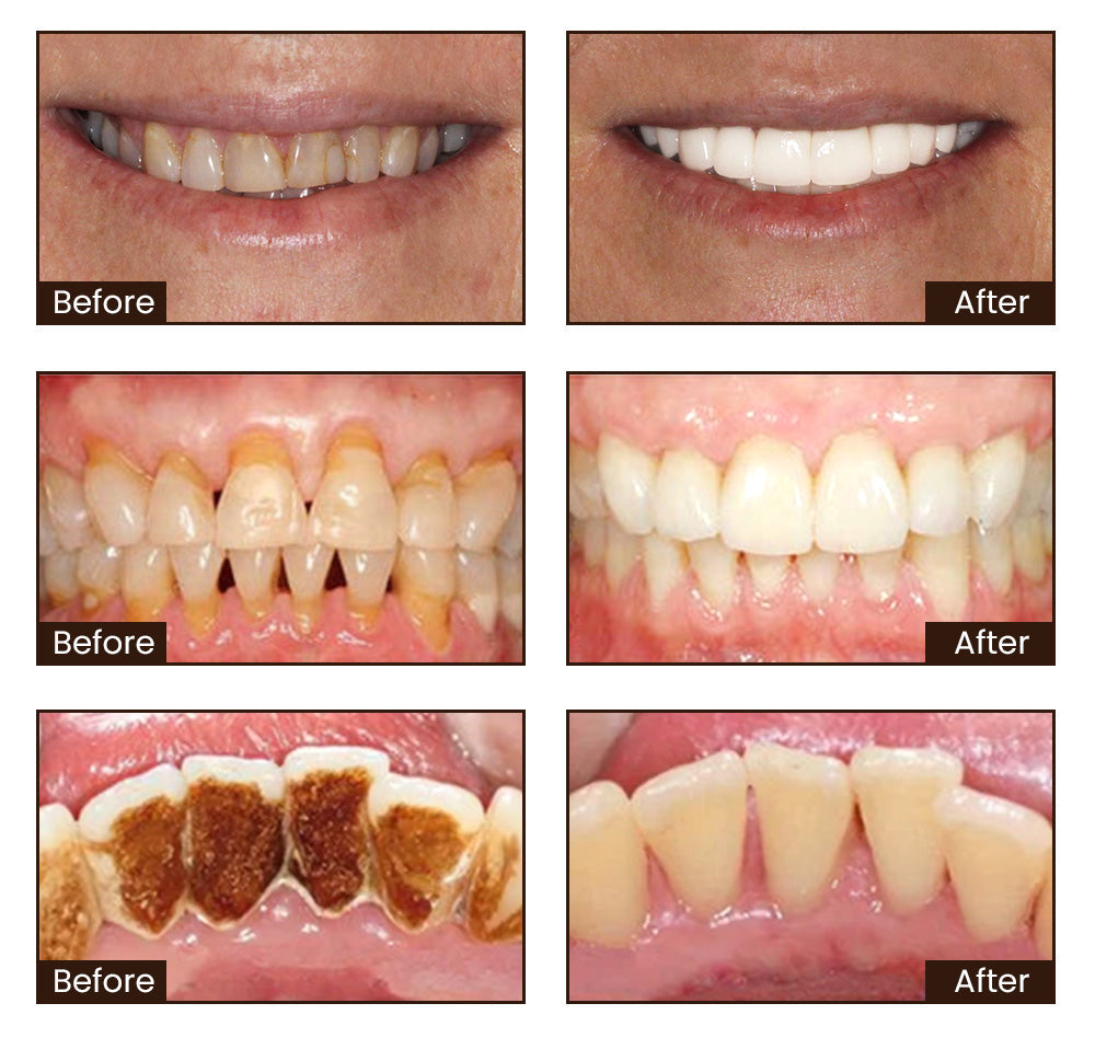 🔥Limited Stock –Niacinamide Whitening Toothpaste