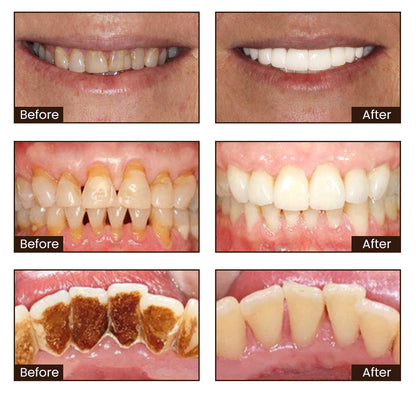🔥Limited Stock –Niacinamide Whitening Toothpaste